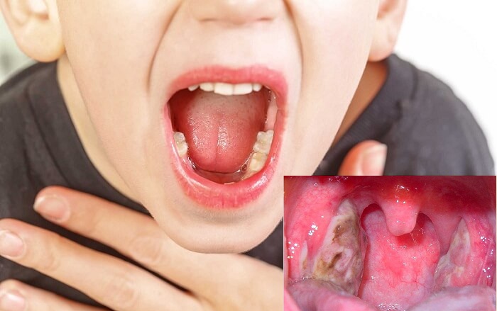 Viêm họng hạt ở trẻ có nguy hiểm không? 