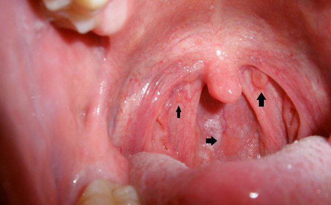 Tiết lộ 6 dấu hiệu của bệnh ung thư vòm họng