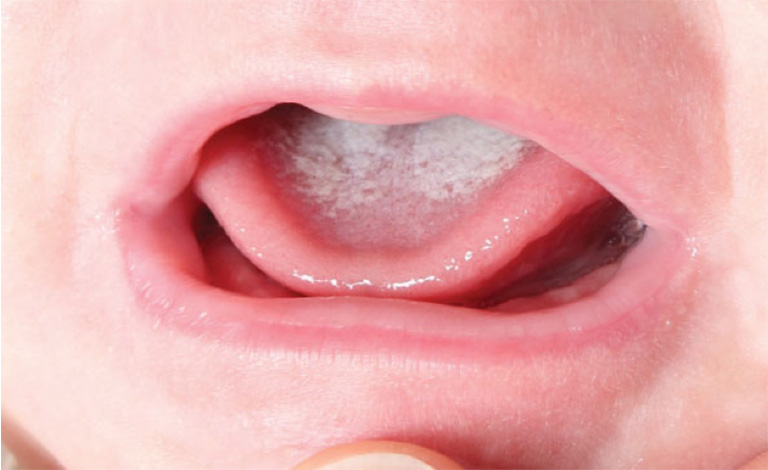 Nguyên nhân khiến lưỡi trẻ bị trắng