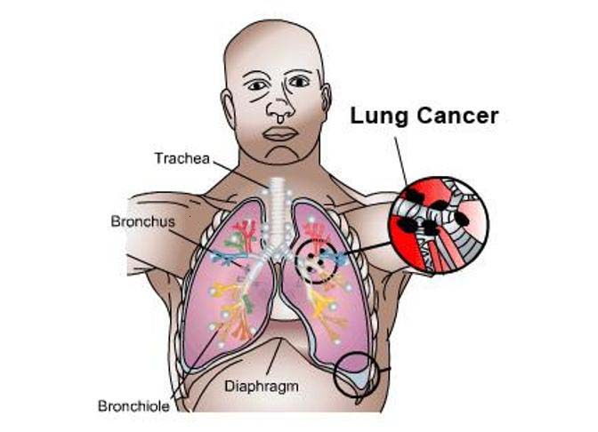 3 biểu hiện của ung thư phổi giai đoạn đầu